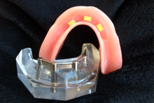 Denture Implants