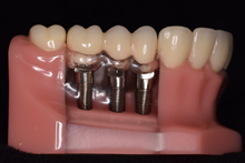 Denture Implants