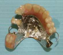 Partial Dentures