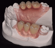 Partial Dentures