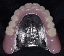Partial Dentures